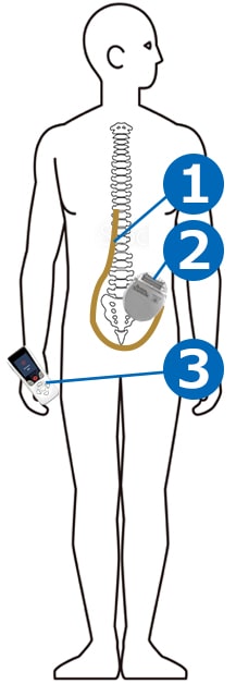 脊髄刺激療法（SCS）で使用される機器