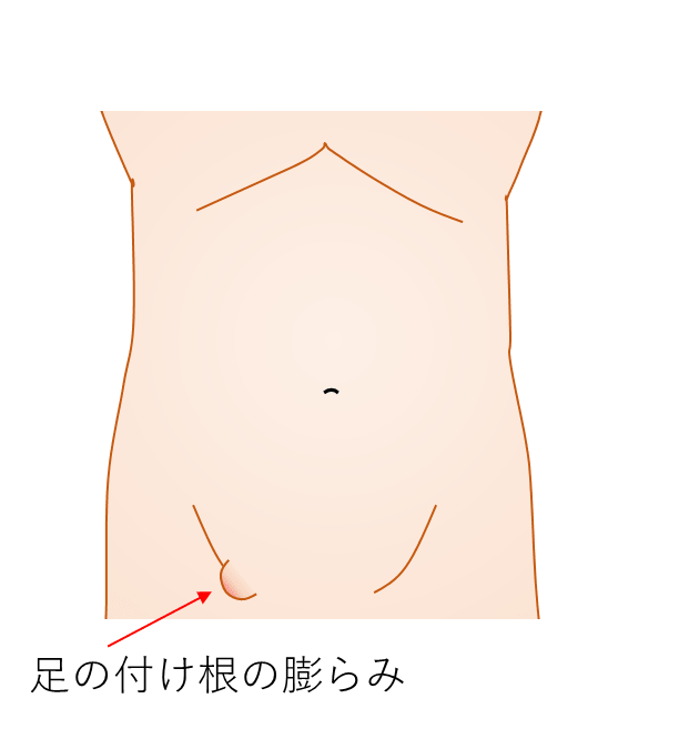 足の付け根の膨らみ