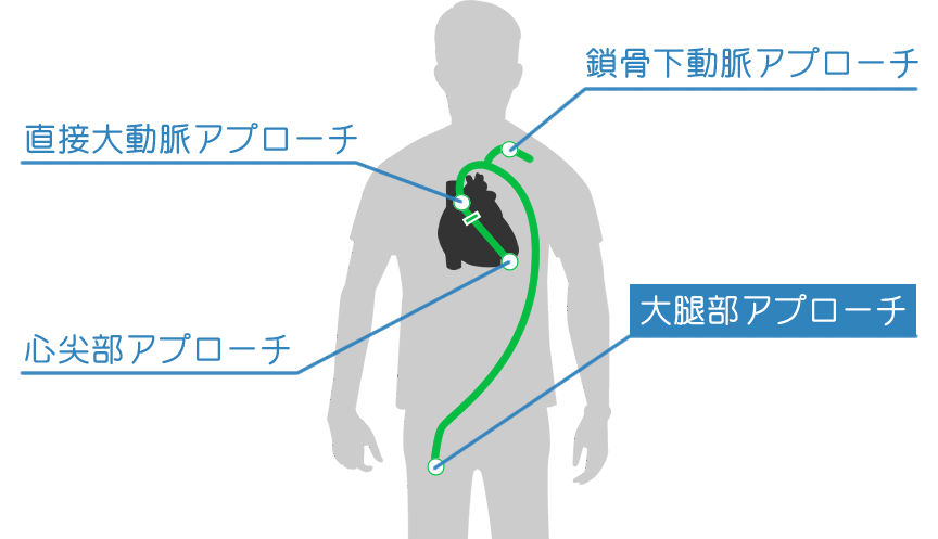 アプローチ