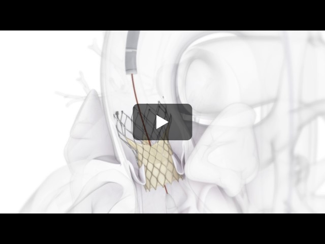 Medtronic Evolut-R PRO を用いた経大腿動脈アプローチ