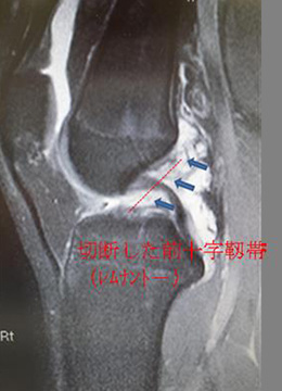 前十字靱帯損傷とその治療法 医療法人社団 誠馨会 新東京病院