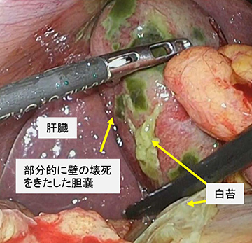 なくなる 胆嚢 ポリープ