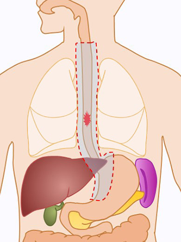 食道切除術で切除される範囲（赤い破線の範囲） 