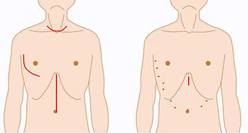 従来の開胸・開腹手術（左）と胸腔鏡・腹腔鏡手術（右）のきずの違い 