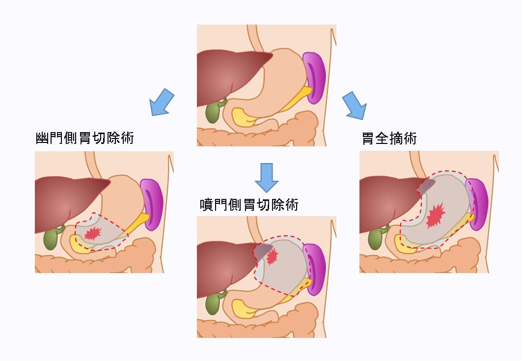 各術式における胃の切除範囲（例）