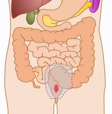 直腸がん手術の切除範囲