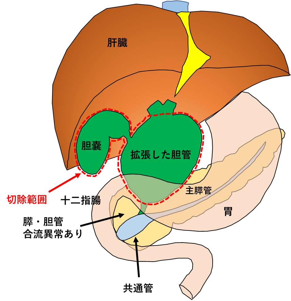 拡張胆管および胆嚢を切除