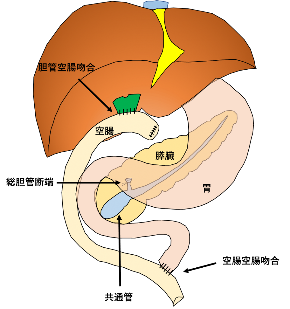 切除、再建後