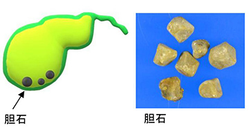 胆嚢 ポリープ 原因