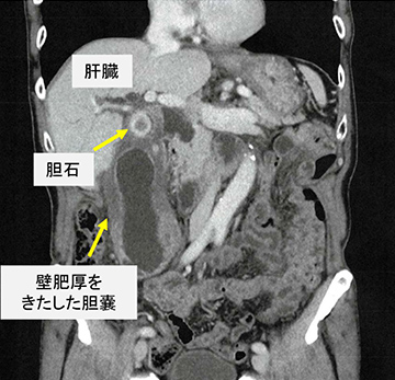 下痢 胆嚢 摘出