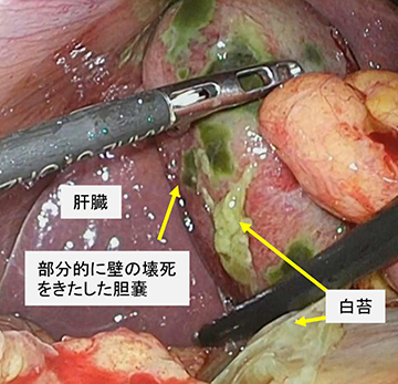 胆嚢 ポリープ 手術