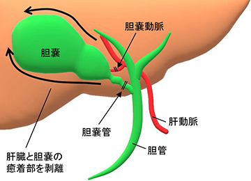 下痢 胆嚢 摘出